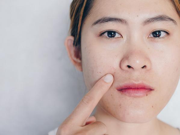 Skin problems caused by wearing face masks